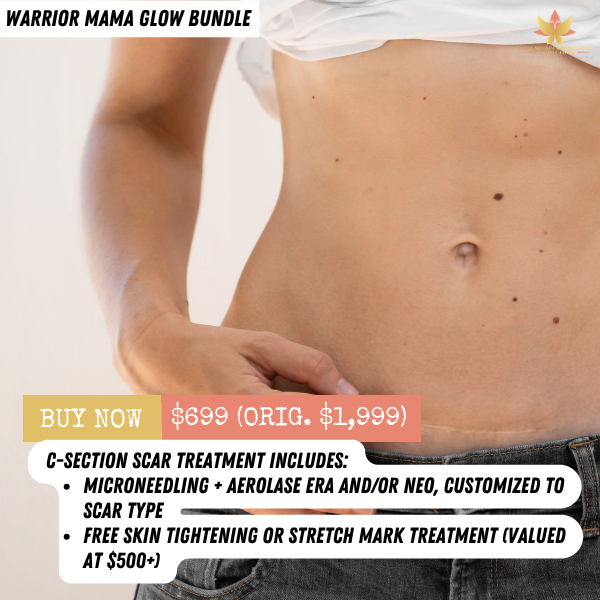 C-SECTION SCAR TREATMENT
