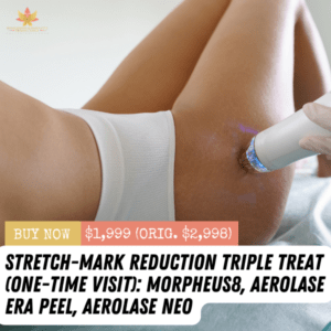 Stretch-Mark Reduction Triple Treat