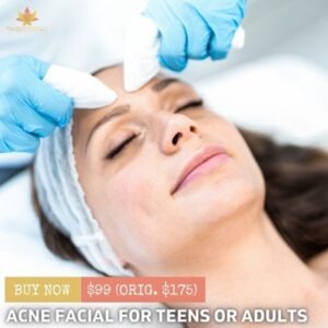 Acne Facial