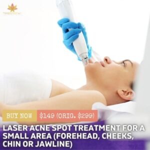 Laser Acne Spot Treatment