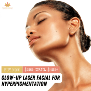 Laser Facial for Hyperpigmentation