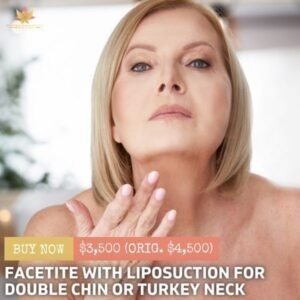 FaceTite With Liposuction