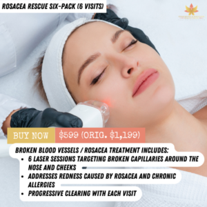 ROSACEA treatment