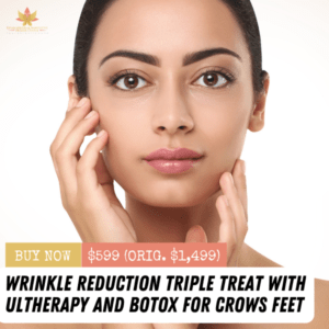 Ultherapy and Botox for Crow's Feet