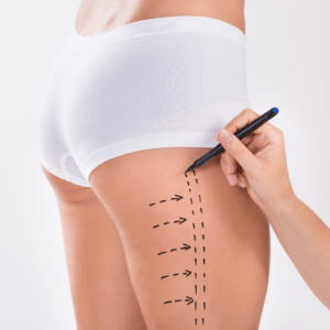 Liposuction Cost in Silver Spring, Maryland
