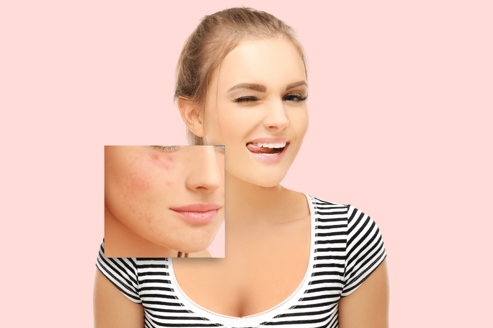 What Is the Best Acne Scar Treatment?