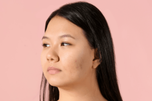 Best Rejuvenation for Hyperpigmentation and Acne in Olney, MD