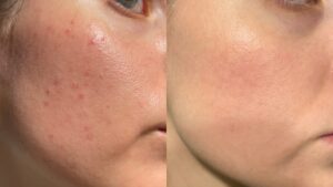 acne scarring treated in Olney MD