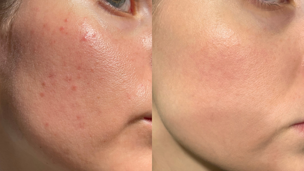 acne scarring treated in Olney MD