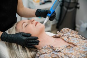 woman looking to treat acne scars with microneedling in Silver Spring