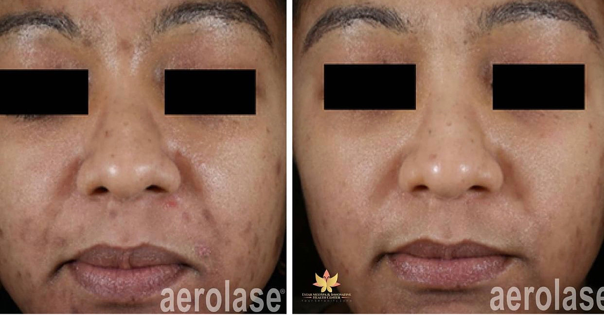 aerolase