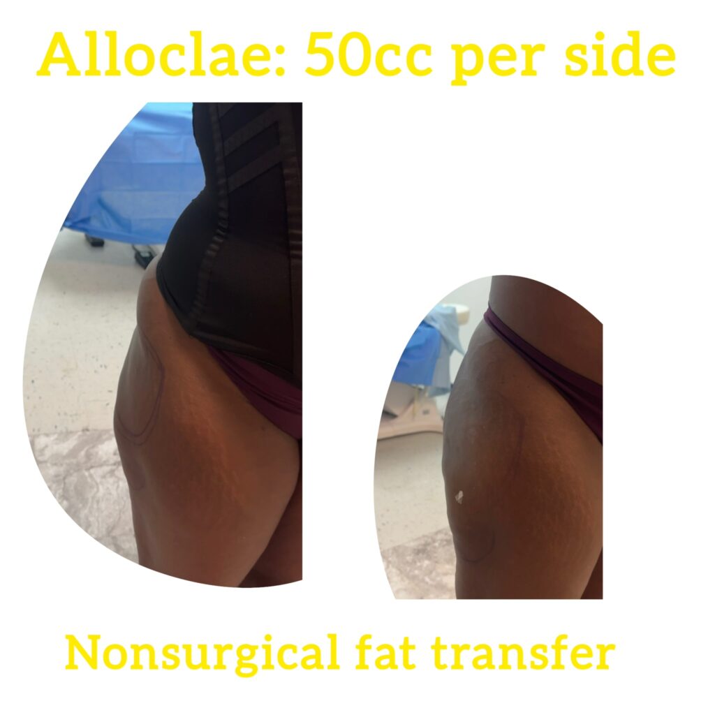 alloclae-13