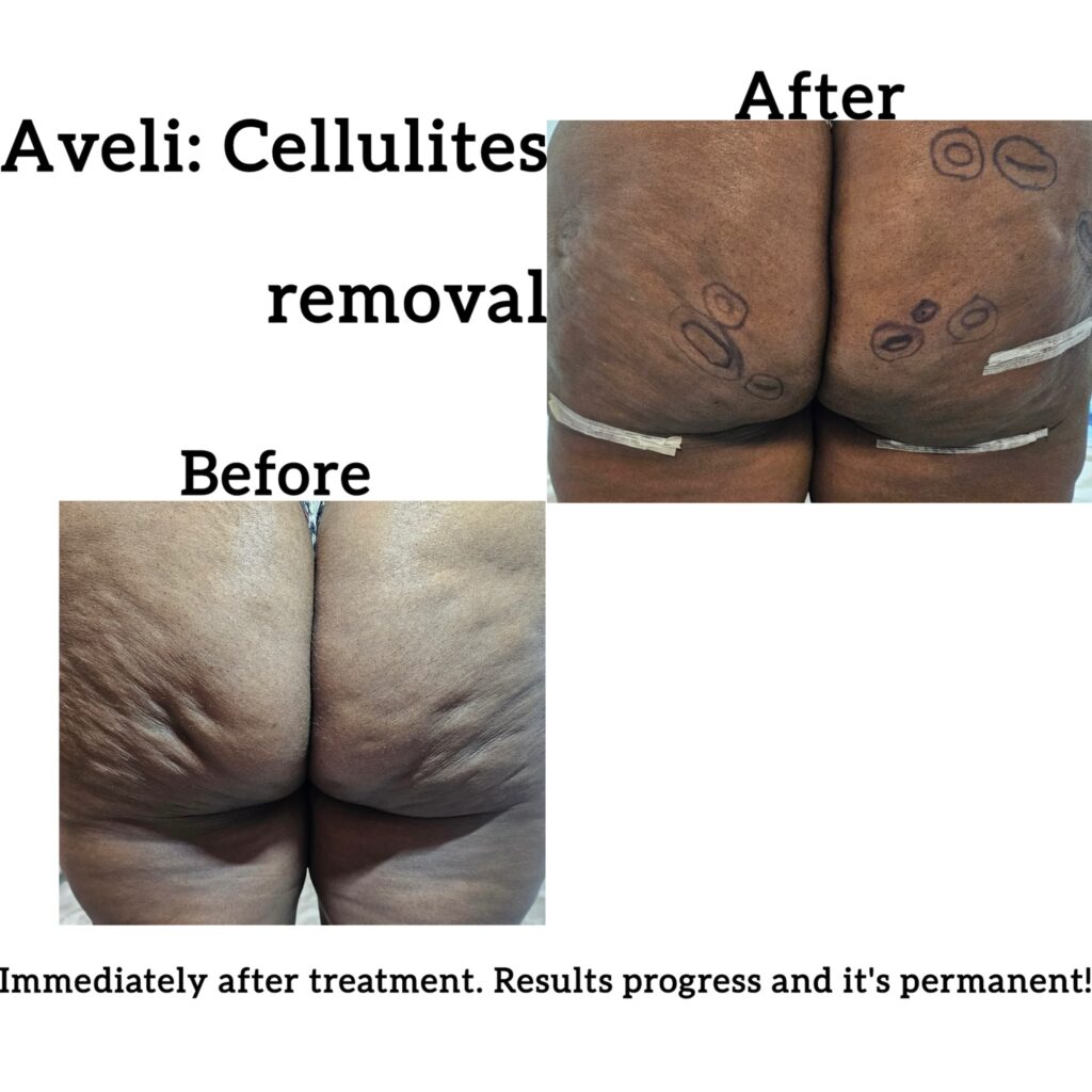aveli-2