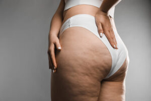 woman in need of Aveli cellulite treatment in Olney