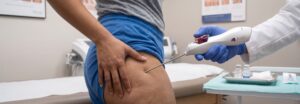 Aveli permanent fix for cellulite in Maryland
