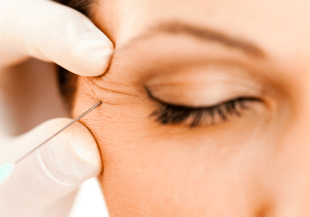 Botox for Crow's Feet in Olney