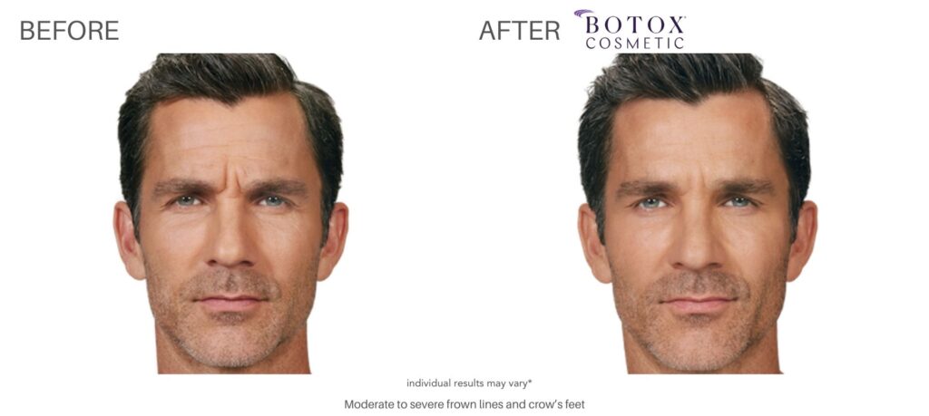 Botox for Men