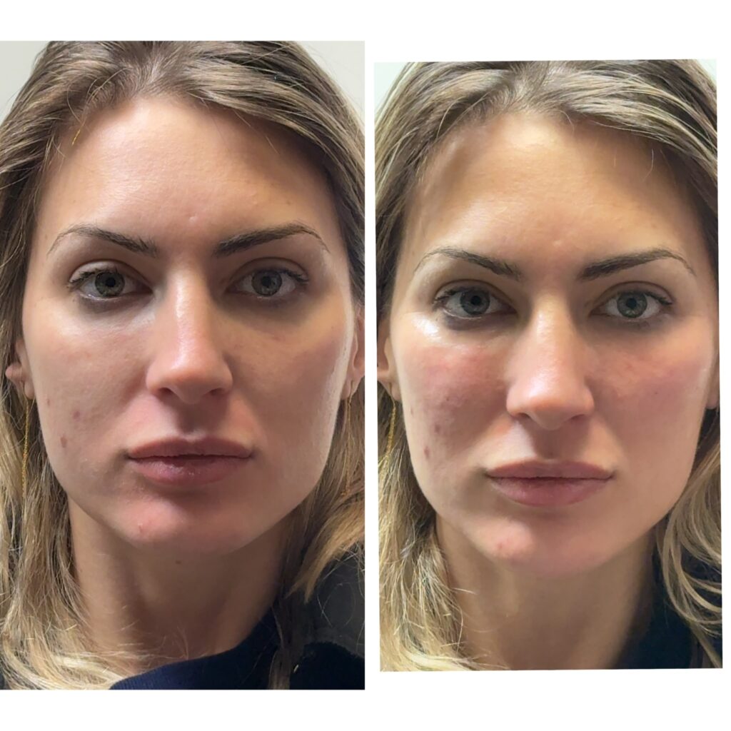 cheek-filler