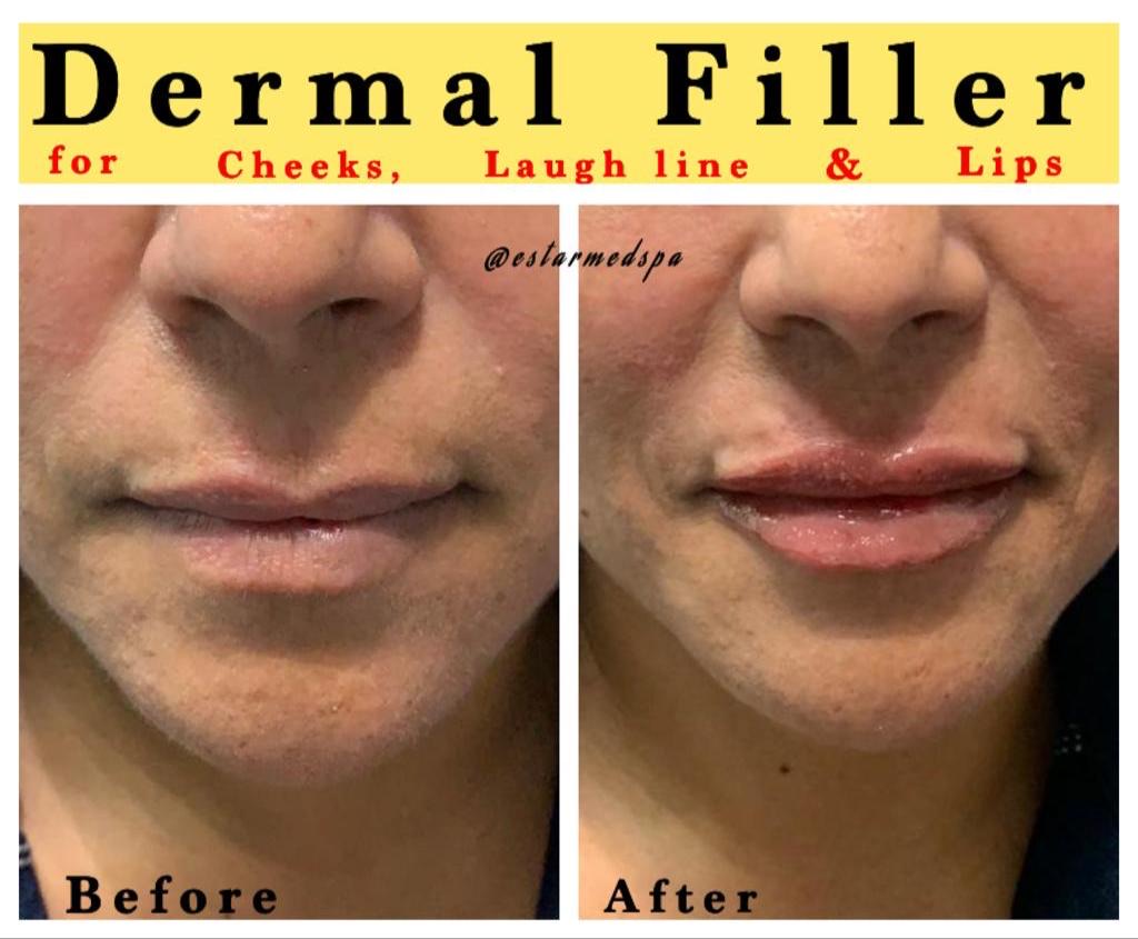 dermal-filler