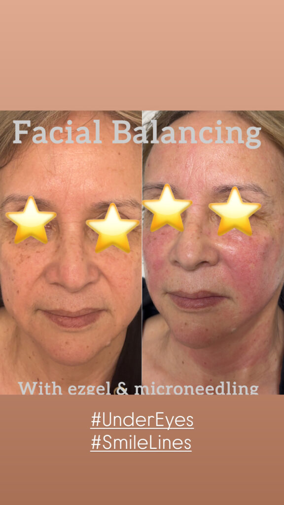 facial-balancing-3
