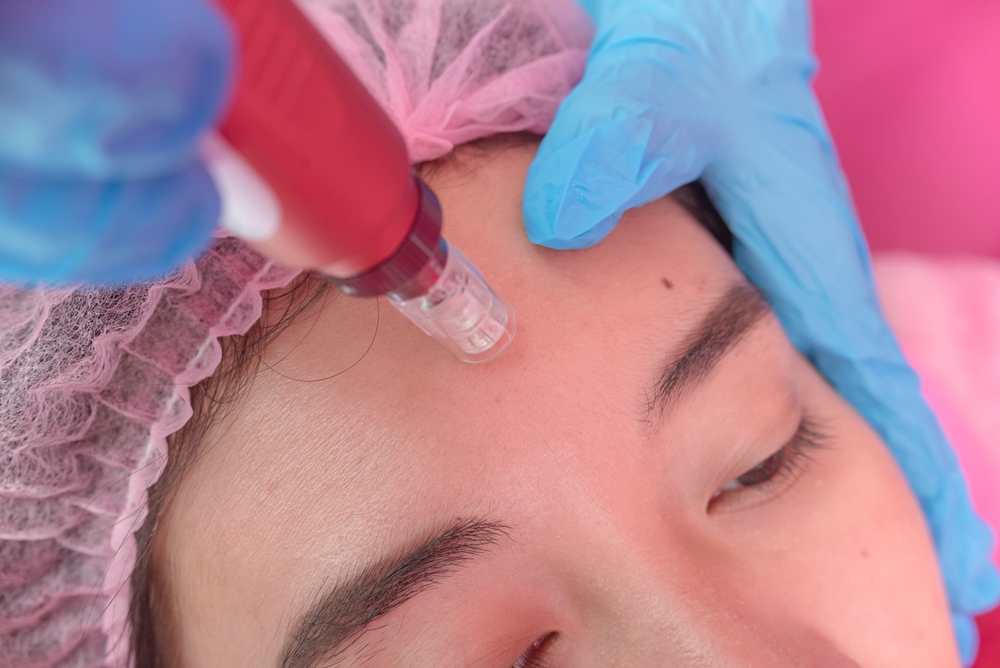 Treat Fine Lines with Microneedling Near Silver Spring, MD