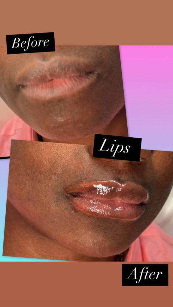 lip-filler-1