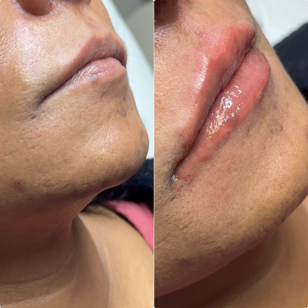 lip-filler