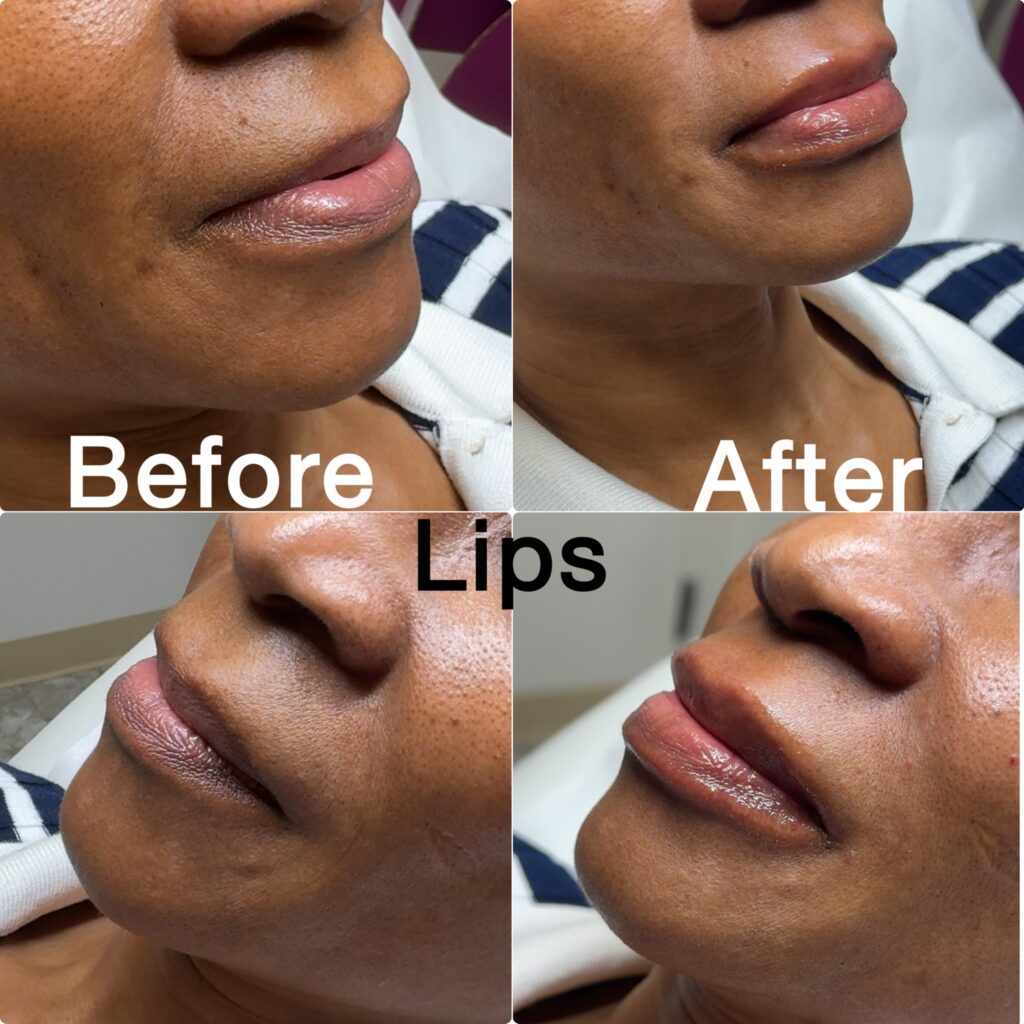lip-filler-2