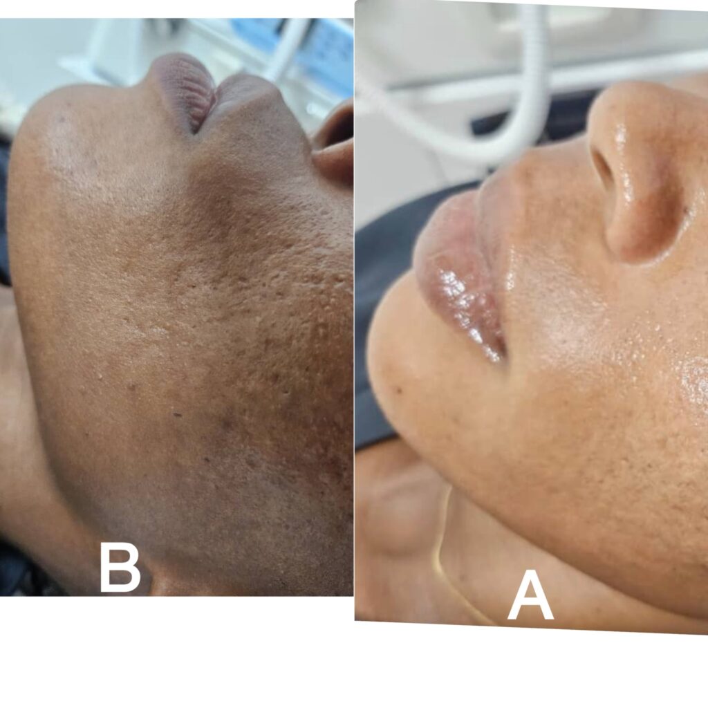 lip-filler-3