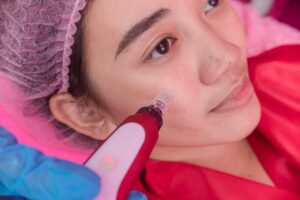 microneedling for acne scars in Olney MD