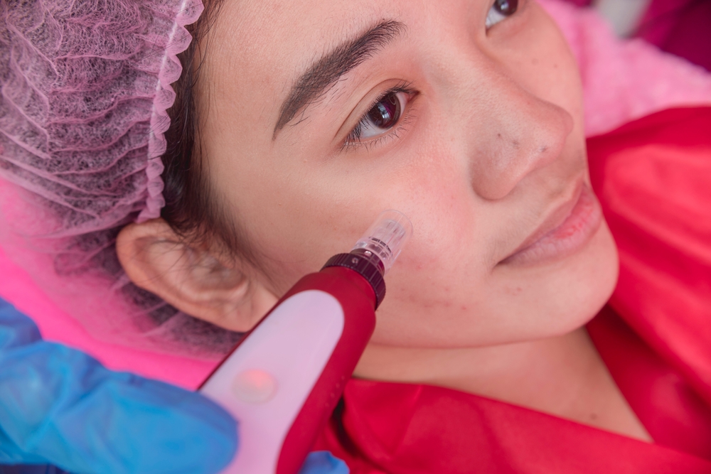 Microneedling for Acne Scars in Olney, MD: A Comprehensive Guide
