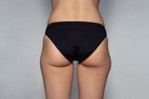 Non-Surgical Treatments for Hip Dips in Olney