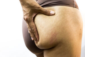 woman in need of Ozempic butt treatments in Olney