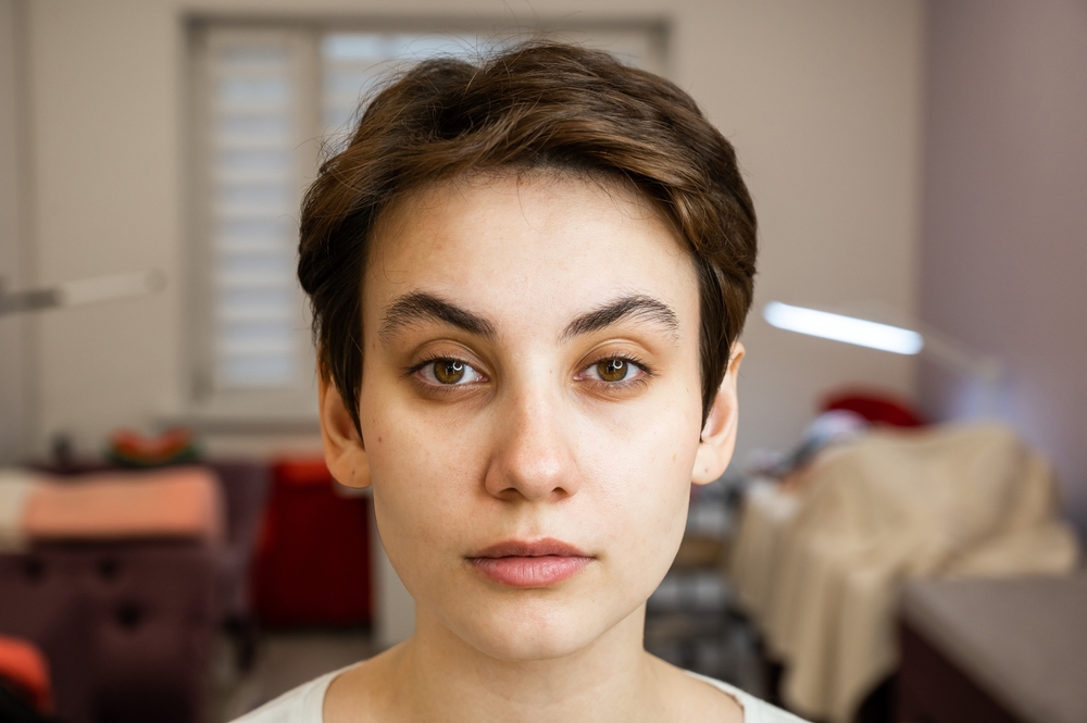 patient considering PDGF to improve under eye hollows