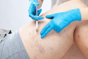 sclerotherapy in Montgomery County MD