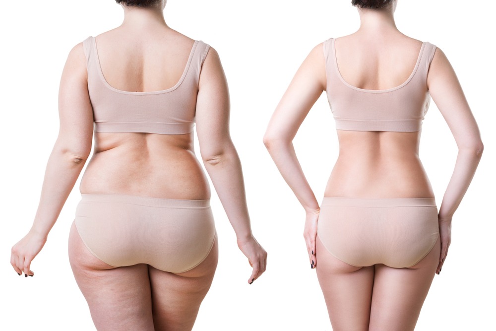 How Much Is Liposuction In North Potomac
