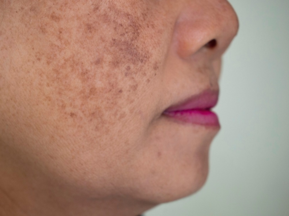 Dark Spot Removal Treatment in Leisure World