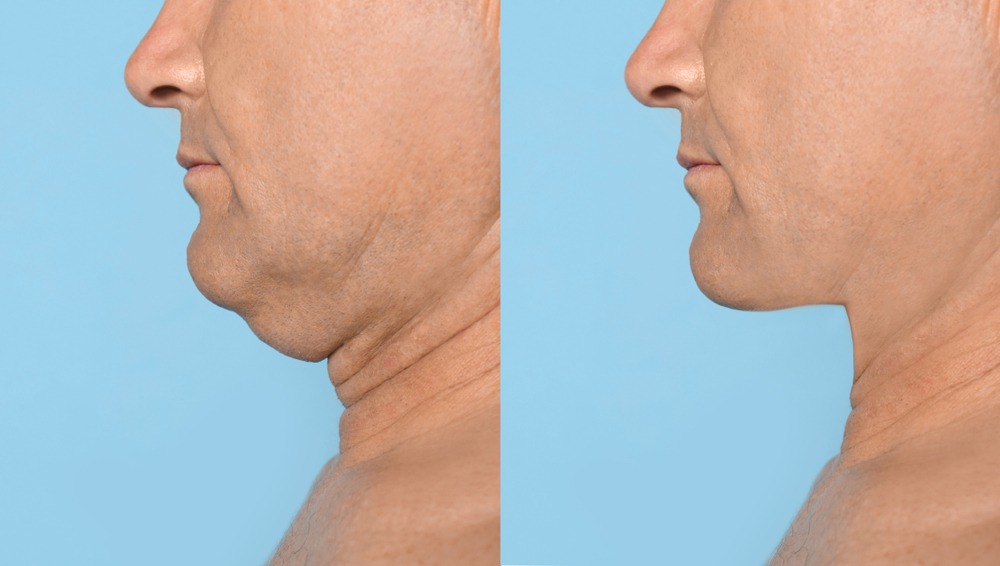 Double Chin Liposuction in Clarksburg Maryland