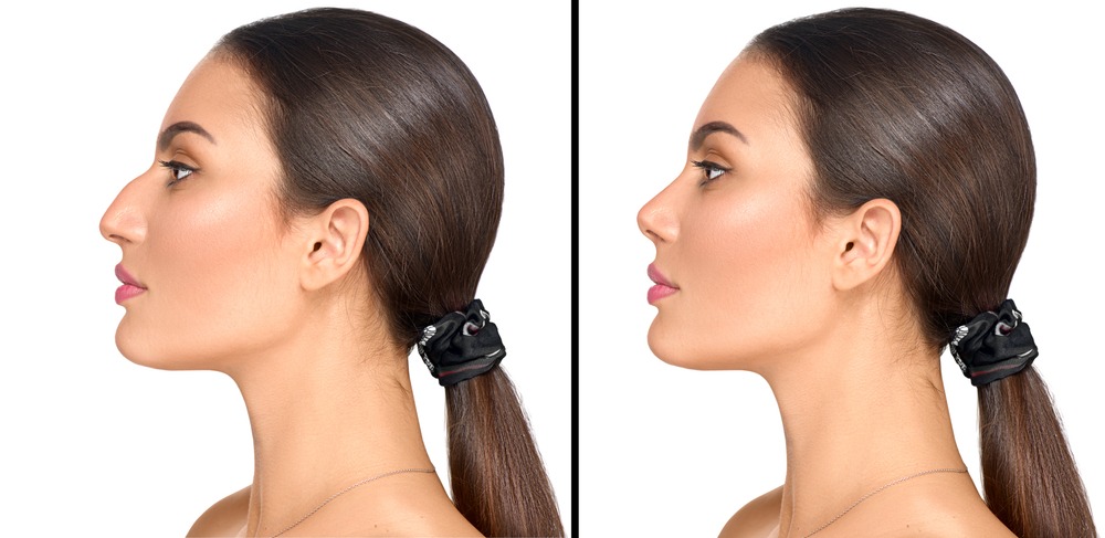 What Is an Ethnic Rhinoplasty With Fillers in Maryland?