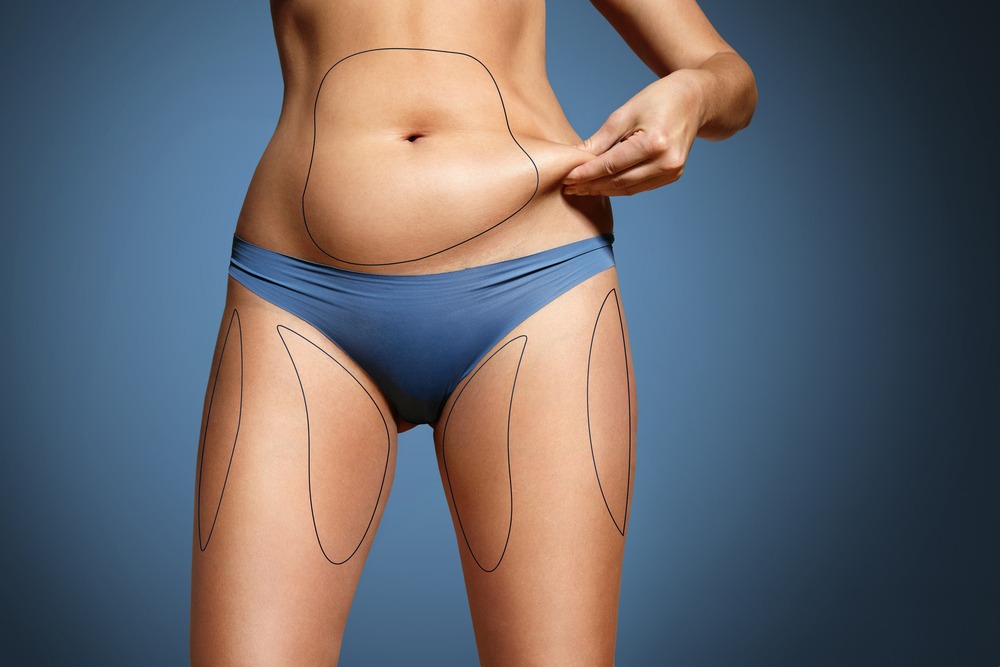 How Safe Is Tumescent Liposuction?