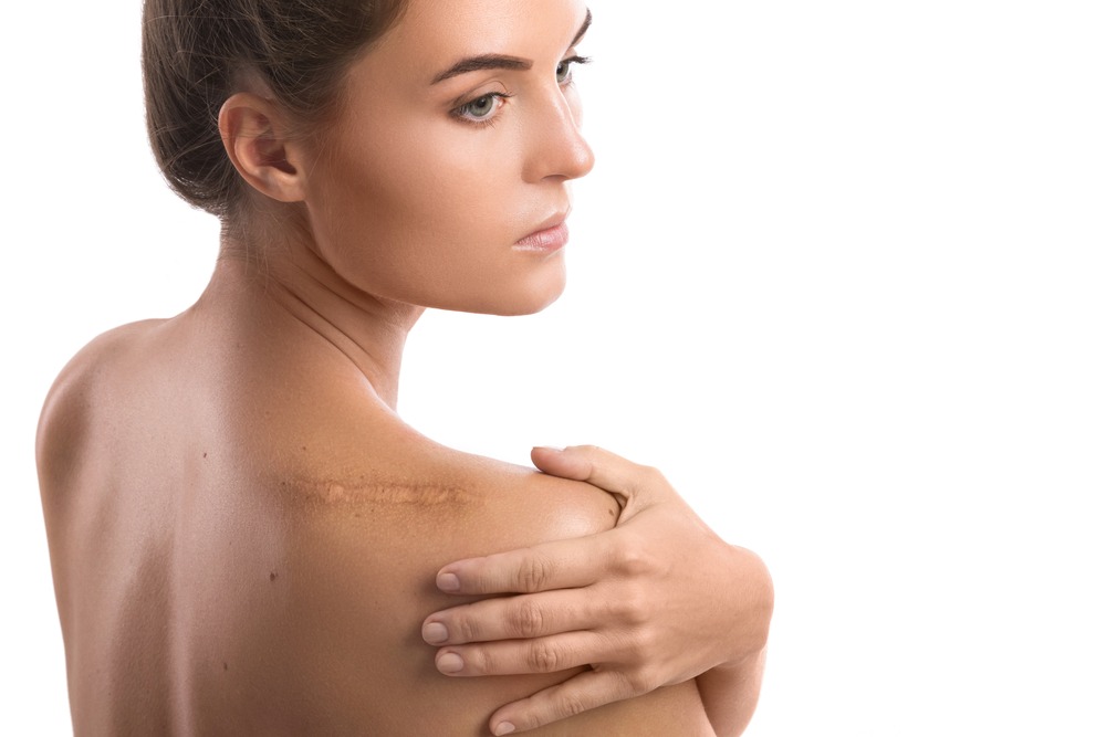 Keloid Scar Treatment and Removal 101