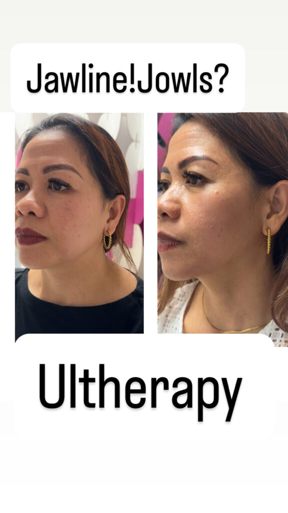 ultherapy