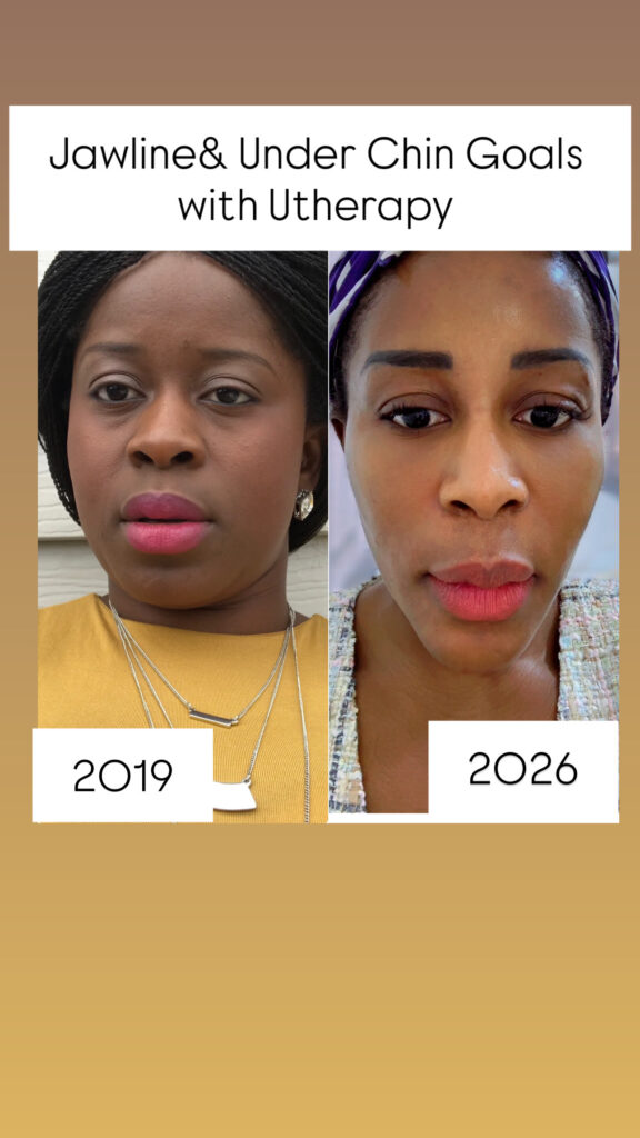 ultherapy5