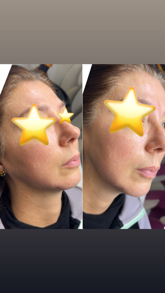 ultherapy6