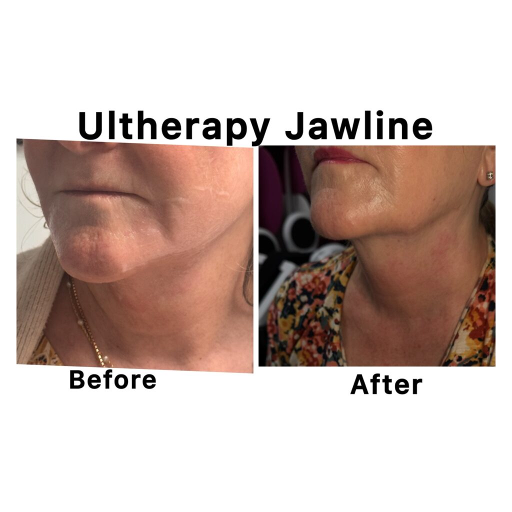ultherapy9