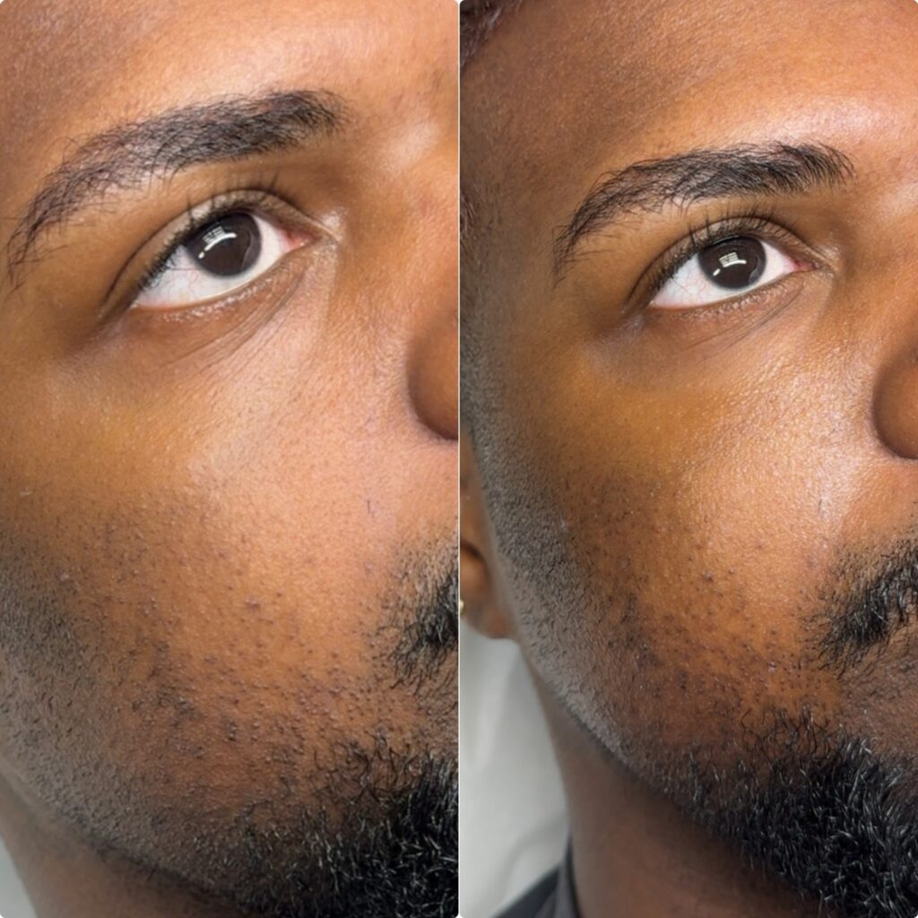 under-eye