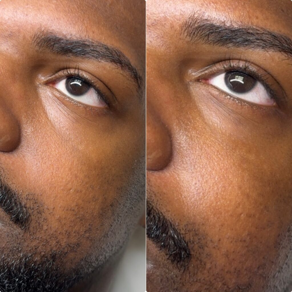 under-eye-3